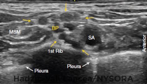 Supraclavicular Brachial Plexus Block For Arteriovenous Hemodialysis ...