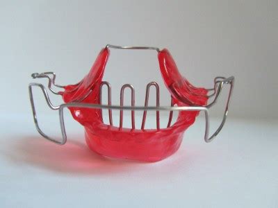 Bionator with Tongue Crib | Functional Appliances | BracesShop.com