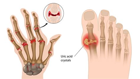 Rheumatoid Arthritis and Gout: What’s the Difference? - Truth About Gout