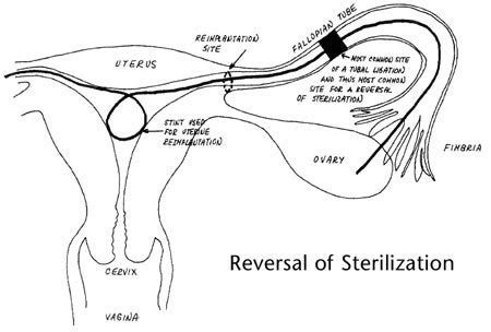 Tubal Ligation Reversal Arizona | ACFS Fertility