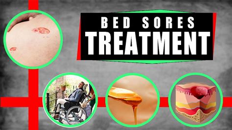 How To Recover From Bed Sores at Xavier Vara blog