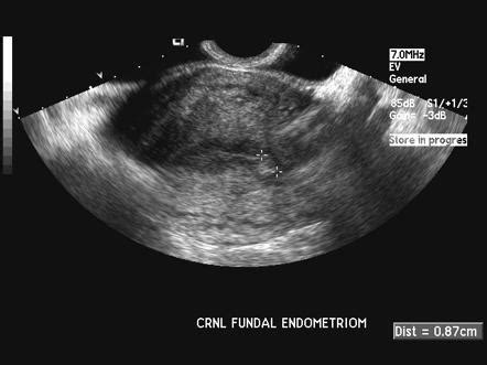 Endometrial Polyp Ultrasound Images