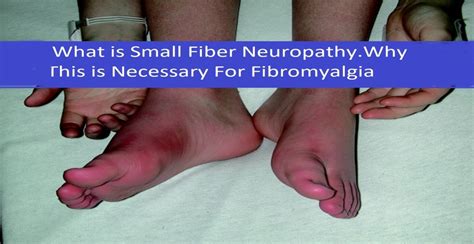 » Small Fiber Neuropathy in Fibromyalgia and CFS