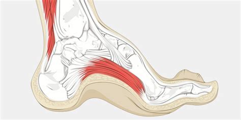 Cavus Foot Deformity | Foot deformities, Muscle tear, Physical therapy shoulder