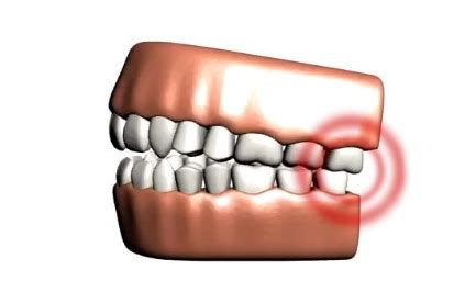 Wisdom Tooth Extraction – Ideal Dental Care – Even28: Dentist Search Engine