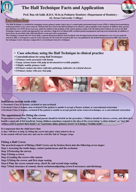 (PDF) • Case selection; using the Hall Technique in clinical practice The Hall Technique Facts ...