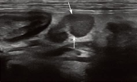 Ultrasonography Of Lymph Nodes, 48% OFF | gbu-taganskij.ru