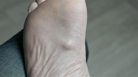 Is This Lump on my Foot Caused by Ledderhose Disease?