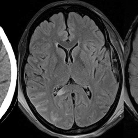 Diffuse Axonal Injury. Same Patient as in Fig. 4. Axial nonenhanced CT... | Download Scientific ...