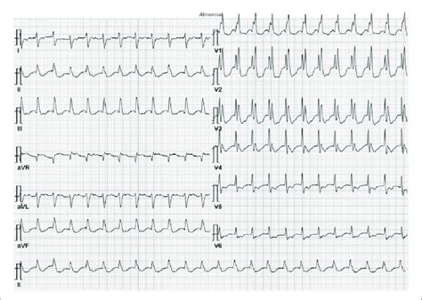 Junctional Tachycardia Vs SVT