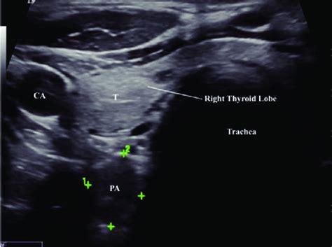 Transverse Ultrasound Of The Neck Shows A Right Inferior Parathyroid | SexiezPicz Web Porn