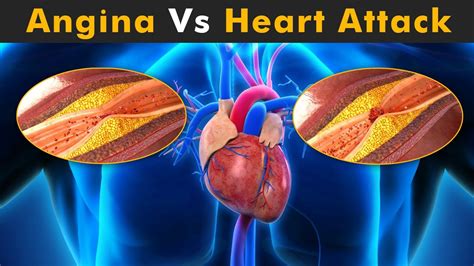 Angina Vs Heart Attack (3D Animation) - YouTube