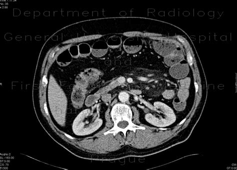 Radiology case: Sclerosing mesenteritis