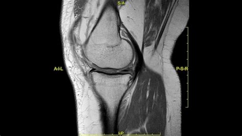 Meniscal root tear - complete MRI examination - YouTube