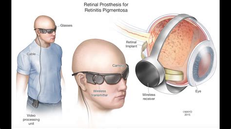 Retinal Prosthesis - Mayo Clinic - YouTube