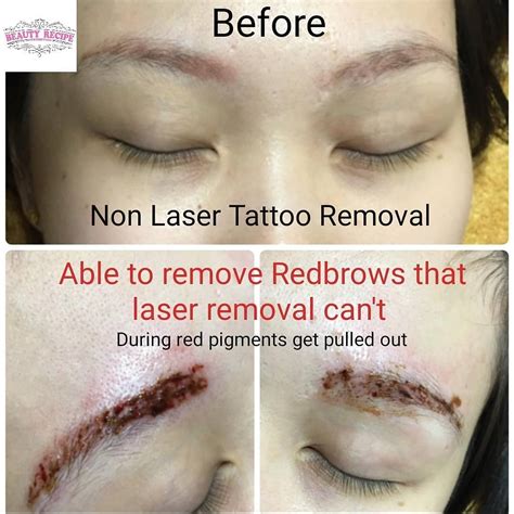 Eyebrow Tattoo Removal Healing Process