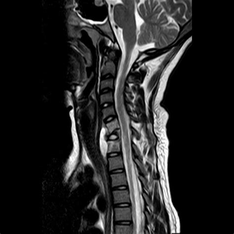 Tuberculosis MRI - wikidoc