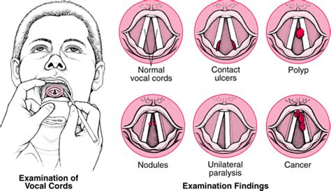 Assessment - Vocal Nodules