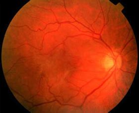 Epiretinal Membrane (Macular Pucker) Surgery & Recovery | Eye Center of Texas