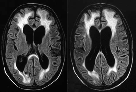 Radiodiagnosis - Imaging is Amazing-Interesting cases: HIV Encephalopathy - MRI