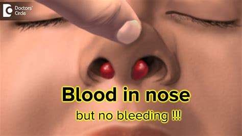 Why Do I Have Bloody Mucus In My Nose? How It Can Be, 40% OFF