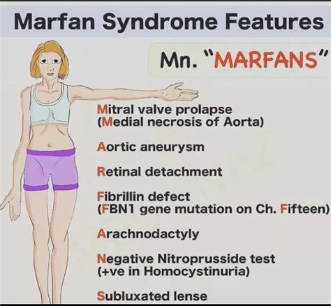 Marfan syndrome - Cause, Symptoms, Treatment - Mobile Physio