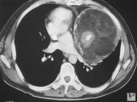 Mediastinal Teratoma | Pet ct, Hemorrhage, Medical imaging