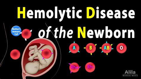 Hemolytic Disease of the Newborn (HDN), Animation - YouTube