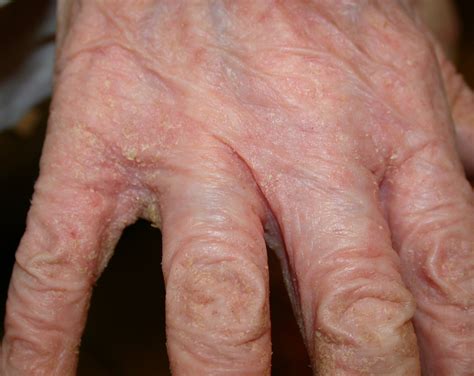 norwegian scabies - pictures, photos