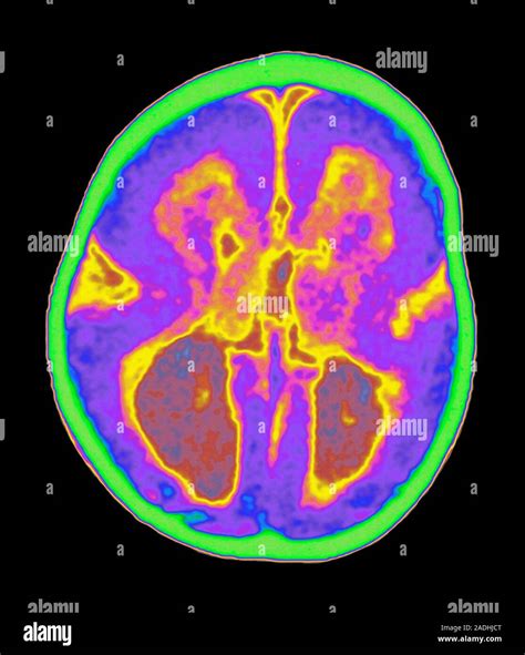 Lissencephaly Mri