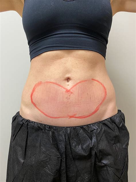 I Tried CoolSculpting — Here’s My Before And After | The AEDITION