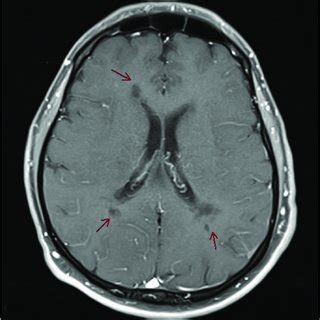 MRI-Brain Sagittal T2 Flair showing hyperintensity in deep white matter ...