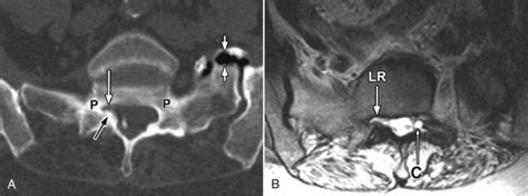 Lateral Recess Stenosis | Radiology Key