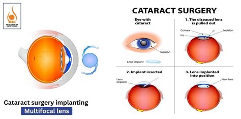 Cataract Surgery Implanting Multifocal Lens – Rotary Eye Hospital