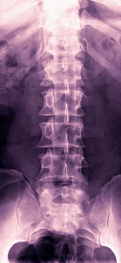 Lumbar Vertebrae X Ray