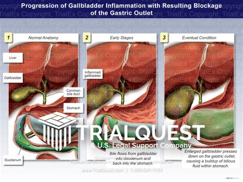 Progression of Gallbladder Inflammation with Resulting Blockage of the ...