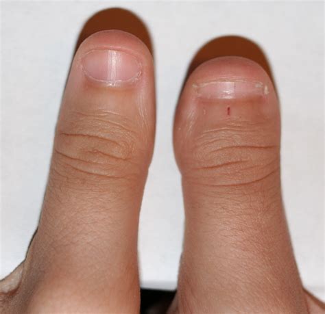 Brachydactyly type D - Wikipedia