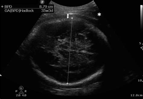 Transabdominal ultrasound image during the third trimester of a normal ...