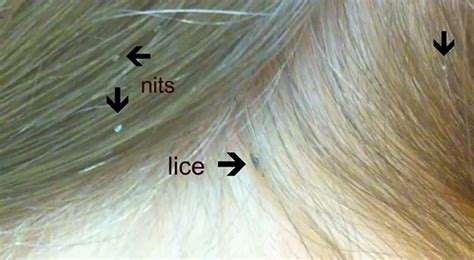 How to Check For Head Lice | Fresh Heads Lice Removal