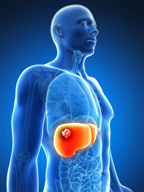 Causes, Symptoms, and Treatment of Liver Cancer