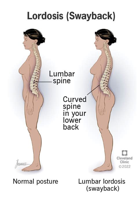 Lordosis Definition, Causes, Symptoms, Diagnosis And, 51% OFF