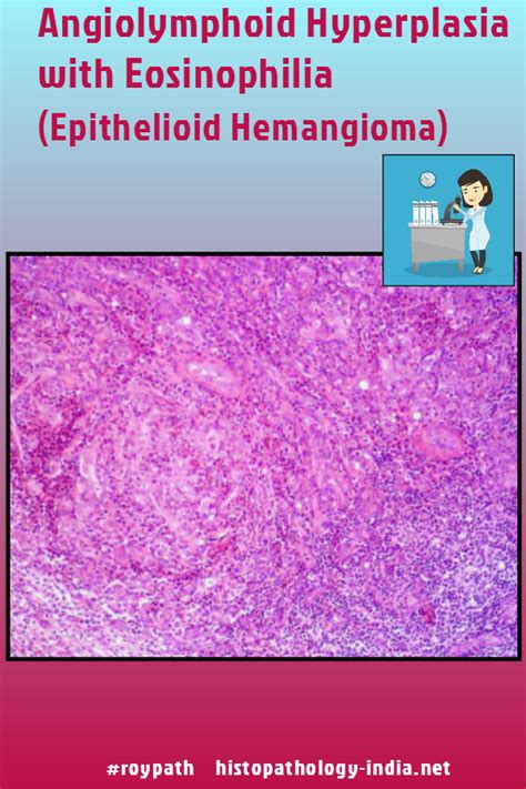 Angiolymphoid hyperplasia with eosinophilia is a rare and benign vascular tumor whose etiology ...