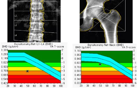 Bone Density Test Chart | My XXX Hot Girl