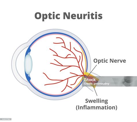 Optic Neuritis Nerve Fibers Are Inflamed And The Optic Nerve Is Swollen Temporary Vision Loss ...