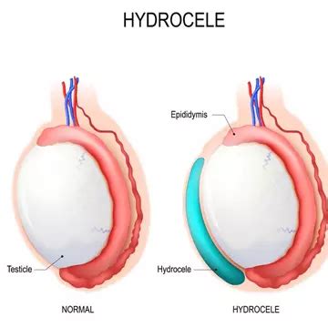 Hydrocele Testis Removal in Dubai | Dubai Cosmetic Surgery Clinic