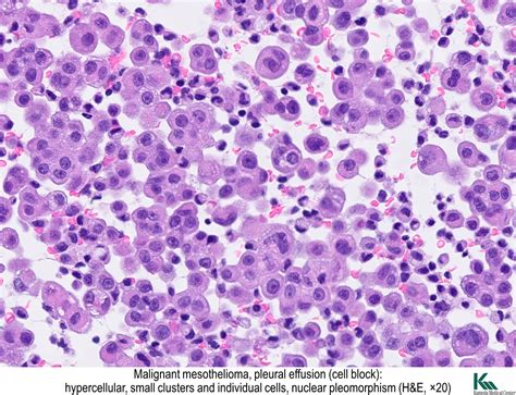 Pathology Outlines - Diffuse malignant mesothelioma