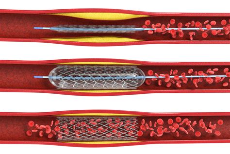 What to Expect Before, During, and After a Protected PCI Procedure ...