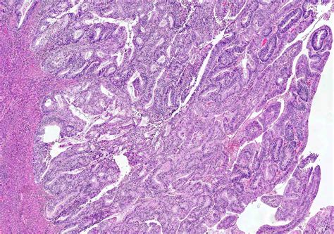 Pathology Outlines - Endometrioid carcinoma