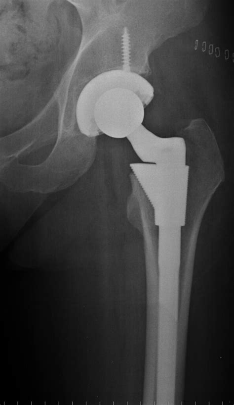 Hip Replacement FAQs - Orthopedic Performance