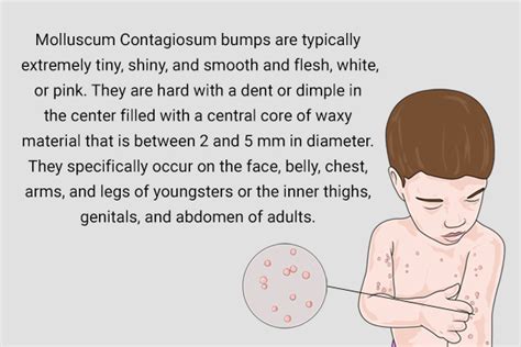 Molluscum Contagiosum Symptoms, Causes, And Treatments, 58% OFF